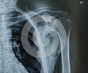 X-ray images of the shoulder and clavicle joint to view tendon and bone injuries for medical diagnosis.