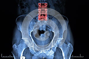 X ray of inflammatory pelvis