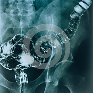 X-ray of the intestine. Radiological examination of a diseased intestine.