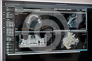 X-ray of the jaw with teeth on a computer monitor. Examination of the oral cavity using digital, medical equipment