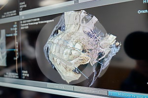 X-ray of the jaw with teeth on a computer monitor. Examination of the oral cavity using digital, medical equipment