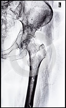 x-ray of junction of tibia and pelvis after healed