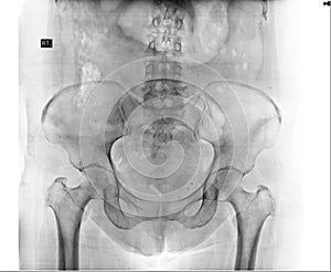 X-ray of kidney-ureter-bladd er (KUB) system.