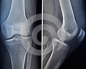 X-ray of a knee