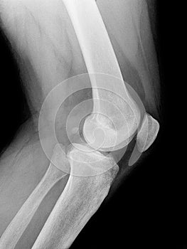 X-ray of the knee