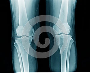 X-ray knee arthritis