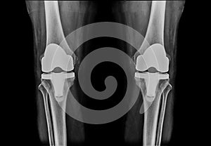 X-ray knee athoplasty