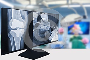 X-ray of the knee, Blurry doctors doing total knee replacement in the operating room background. Orthopedic surgeons use