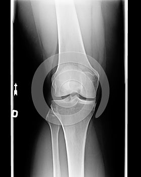 X-ray of knee with Chondromalacia