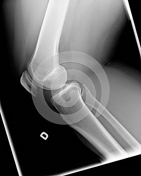X-ray of knee with Chondromalacia