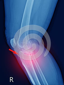 X-ray knee Fracture proximal metaphysis of tibia.Depressed fracture of lateral tibial plateau.severe swelling of soft tissue on