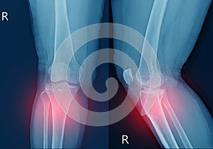 X-ray knee Fracture proximal metaphysis of tibia.Depressed fracture of lateral tibial plateau.severe swelling of soft tissue on