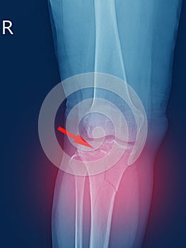 X-ray knee Fracture proximal metaphysis of tibia.Depressed fracture of lateral tibial plateau.severe swelling of soft tissue on