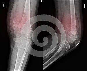 X-ray Knee join Showing large osteolytic lesuion of medial aspect of left distal femur.with soft tissure mass.and malignant bone t photo