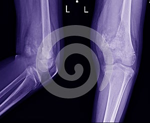 X-ray Knee join Showing large osteolytic lesuion of medial aspect of left distal femur.with soft tissure mass.and malignant bone t