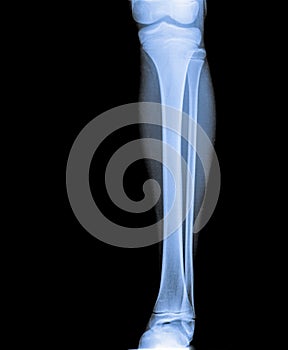 X ray of Knee joint with femur, tibia and fibula bone.