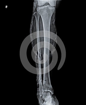 X ray of Knee joint with femur, tibia and fractured fibula bone.