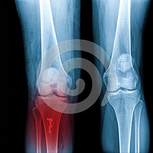 X-ray Knee Joint Fracture proximal tibia and Post fix fracture proximal tibia with plate and screws, highlighted in red