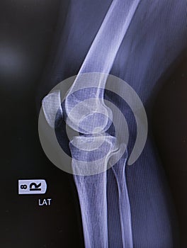 x-ray of knee joint side view. normal joint and space, Medical image concept