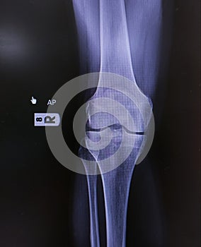 x-ray of knee joint side view. normal joint and space, Medical image concept