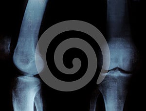 X-ray of the knee-joints