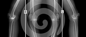 X-ray of knee joints. Deforming osteoarthritis.