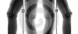 X-ray of knee joints. Deforming osteoarthritis. Negative.