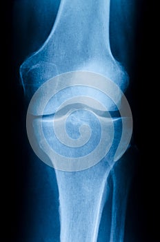 X-ray of the knee photo