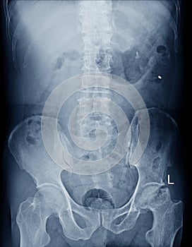 X-ray L-S spine AP. views showing Compression fracture L1 vertebral body. Medical image concept