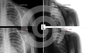 X-ray of the left collarbone. Fracture of clavicle of the child. Consolidation of the fracture. Marker. Positive. Negative.