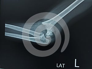 X-ray Left Elbow supracondylar fracture of the humerus with elbow dislocation