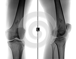 X-ray of the left knee joint. Ewing sarcoma, lymphoma, myeloma thigh bone. Negative.