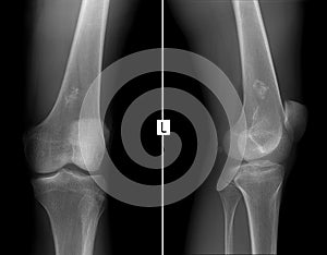 X-ray of the left knee joint. Ewing sarcoma, lymphoma, myeloma thigh bone. photo