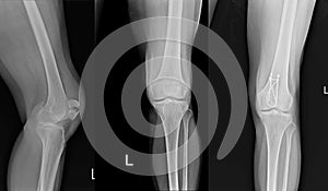 X-ray Left Knee lateral Showing Kneecap fracture and Post operation fixation with K-wire.