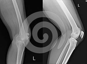 X-ray Left Knee lateral Showing Kneecap normal and fracture