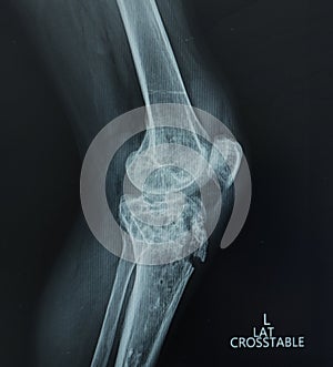 X-ray Left Knee Lateral view. Avulsion fracture tibial tubercle, Medical image concept.