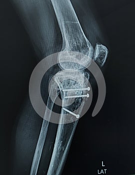 X-ray Left Knee Lateral view. Avulsion fracture tibial tubercle, post - fixation