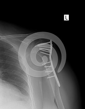 X-ray of the left shoulder. Fracture of the shoulder with metal.