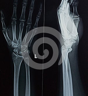 X-ray of left wrist with fracture line on distal radius bone
