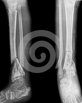 X-ray of leg