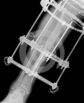 X-ray of leg with fixation