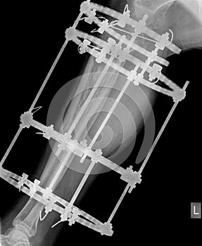 X-ray of leg with fixation