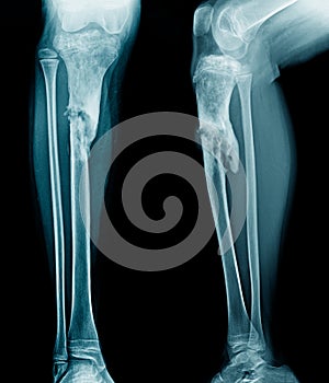 Osteomyelitis tibia