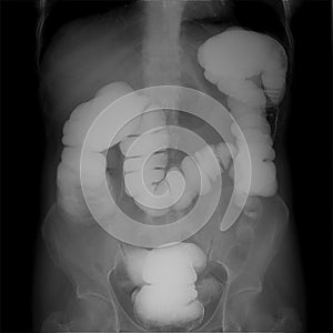 X-ray of the lower parts of the gastrointestinal tract GI. Tight filling. Chronic colitis.