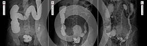 X-ray of the lower parts of the gastrointestinal tract GI. Tight filling. Emptying. Insufflation by air. Chronic colitis.