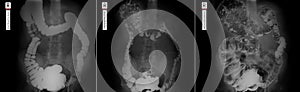 X-ray of the lower parts of the gastrointestinal tract GI. Tight filling. Emptying. Insufflation by air. Dolichocolon.