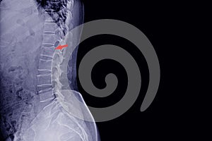 X-ray lumbar spine fracture L1 on red point