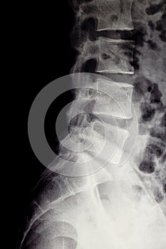 X-ray of the lumbar spine with herniated disc