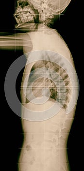 X-ray lumbo-sacral spine and head