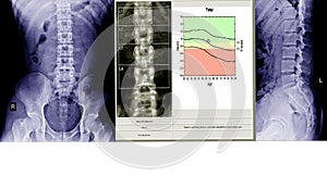 X-ray lumbo-sacral spine and pelvis and inflammation at spine and bone densitometry spine healthcare hospital technology concept